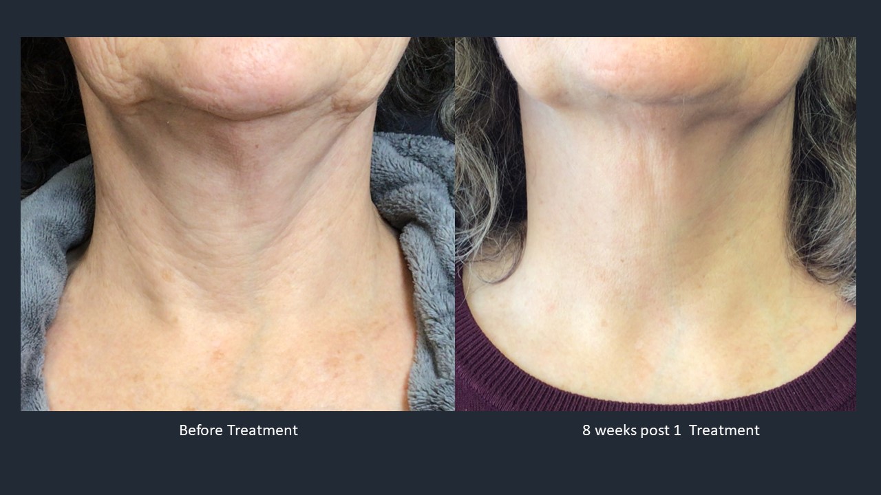 Skin Tightening Resurfacing With Opus Plasma Renew Medspa