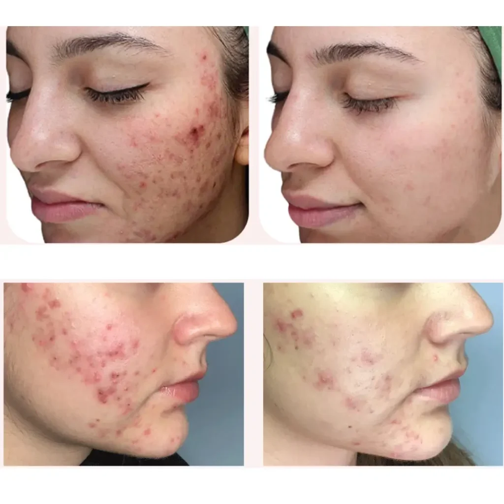 Acne Treatment Before and After Photos