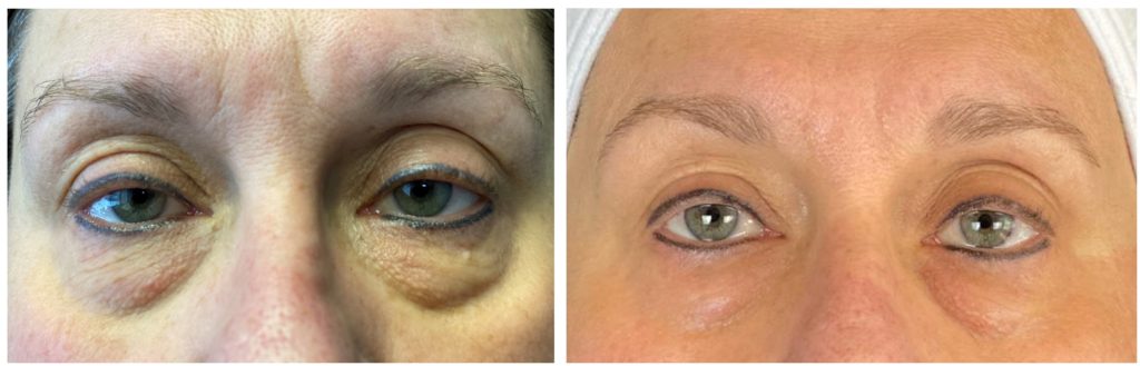 Plasma Pen Treatments | Eagan, MN | Renew MedSpa