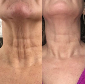 Plasma Pen Neck Lift Before and After photos