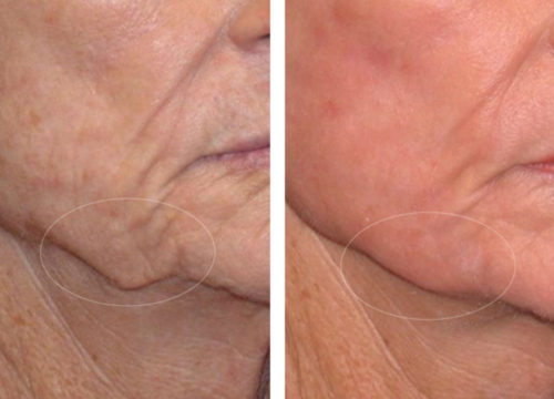 Plasma Resurfacing before and after