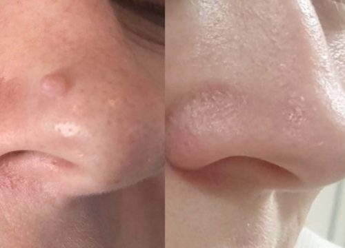 Moles