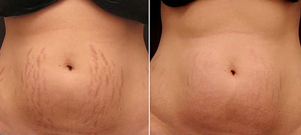 Stretch Marks & Weight Loss: Everything You Need To Know - SOG