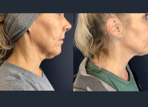 Plasma Pen Neck Lift Before and After Photos