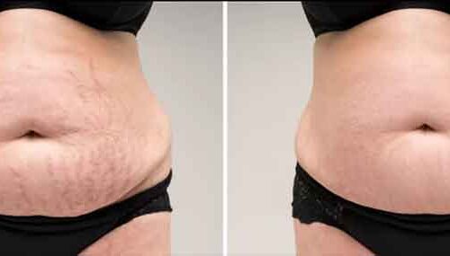Stretch Mark & Scar Removal