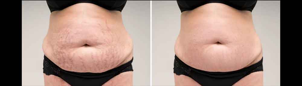 Stretch Mark & Scar Removal
