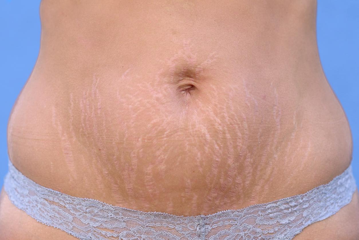 What is the most effective treatment for Stretch Marks? - Ink