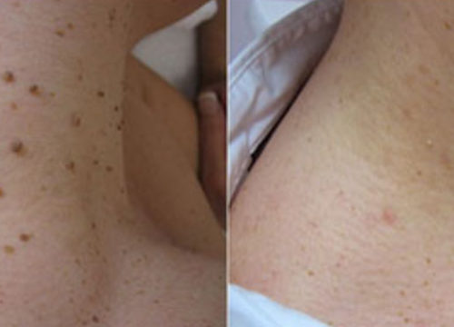 Moles and Skin Tag Removal