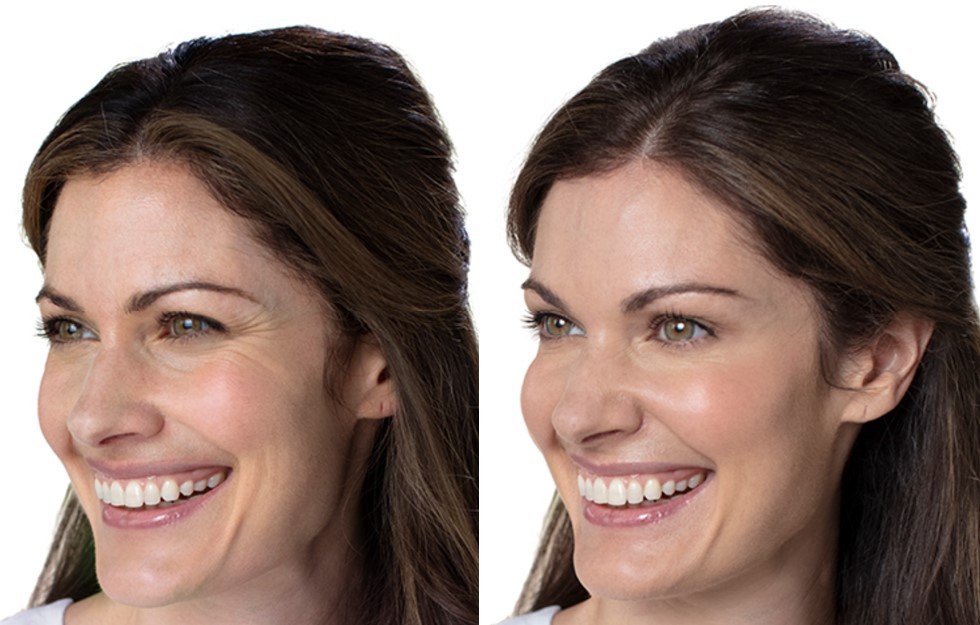 Before and after neuromodulator treatment of crow's feet, female patient, Renew MedSpa Eagan MN