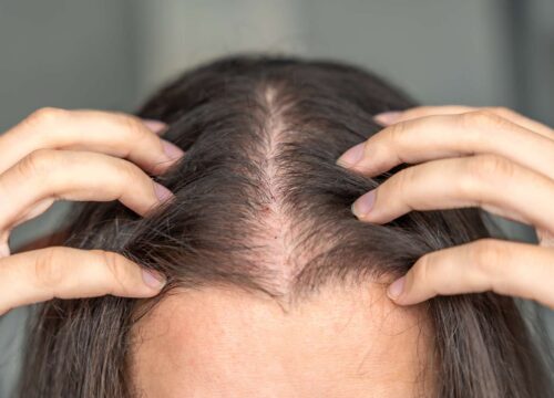 hair loss