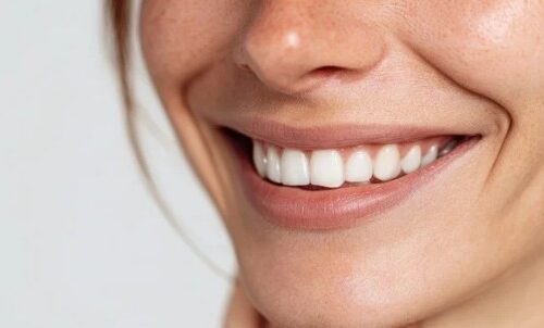 Nasolabial Fold (Smile Line) Wrinkles
