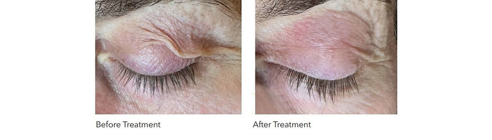 Can an Upper Lid Blepharoplasty Be Too Aggressive?