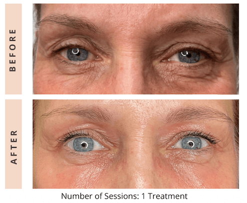 Eyelid & Undereye Skin Tightening