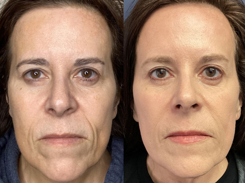 Sculptra Before and After 2 Treatments
