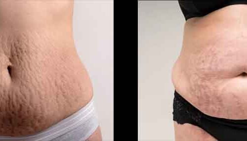 Stretch Marks