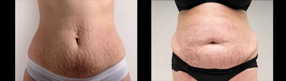 Stretch Marks