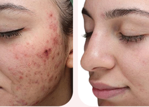 Acne & Acne Scarring