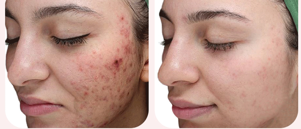 Acne & Acne Scarring