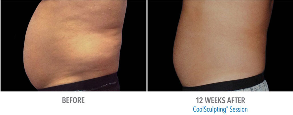 CoolSculpting before and after