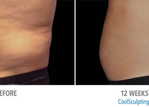 CoolSculpting before and after