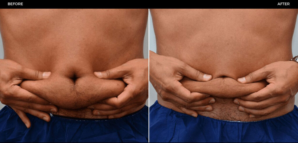 Before and after CoolSculpting