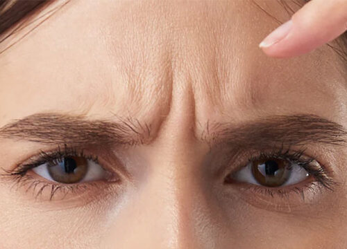 Frown Lines — What they are and how to treat them