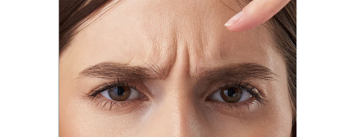 Frown Lines — What they are and how to treat them