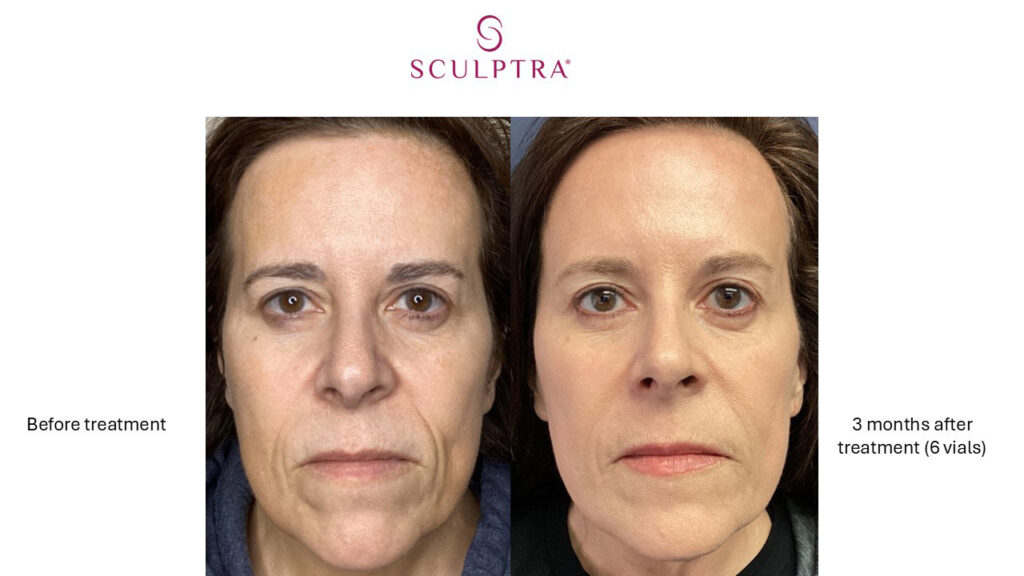 Sculptra Before and After 6 vials