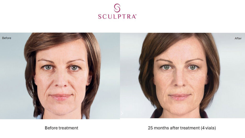 Sculptra Before and After 4 vials