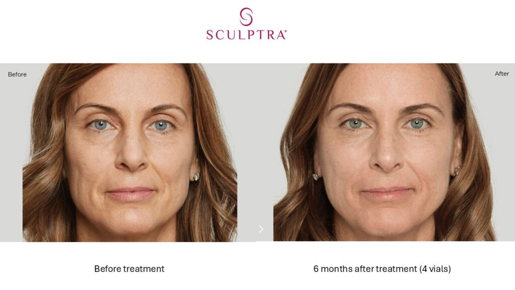 Sculptra Before and After 4 vials