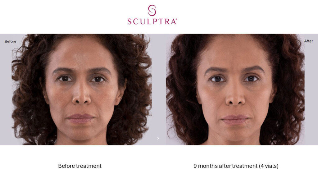 Sculptra Before and After 4 vials