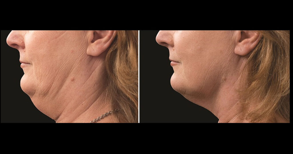 CoolSculpting on Chin