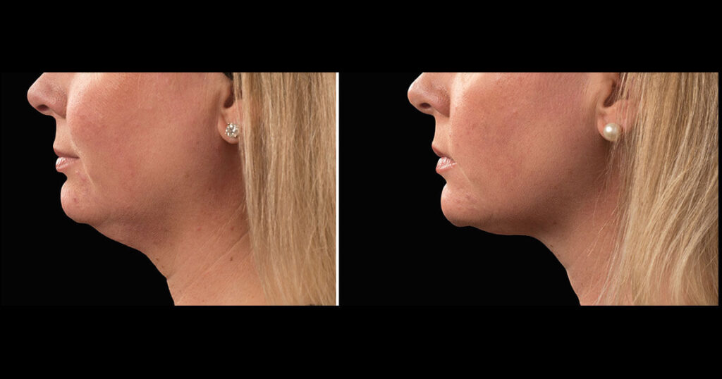 Chin Before and After 