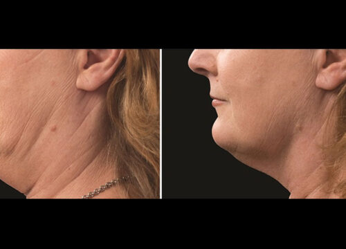 CoolSculpting on Chin