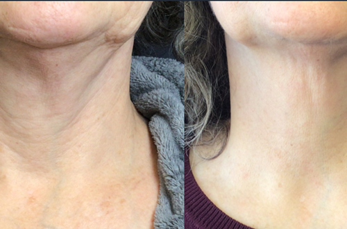 Understanding Aging Neck Skin — Causes, Prevention, and Treatments