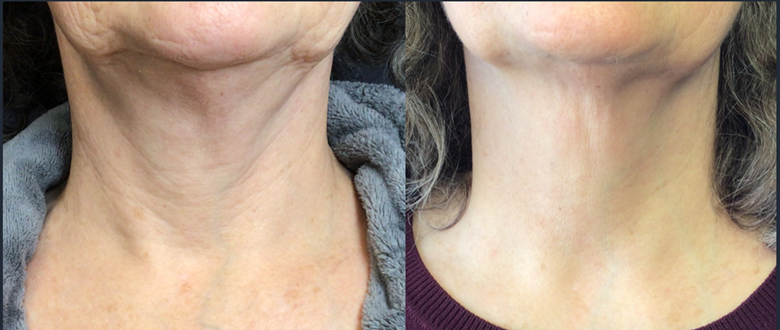 Understanding Aging Neck Skin — Causes, Prevention, and Treatments