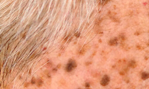 Seborrheic Keratosis