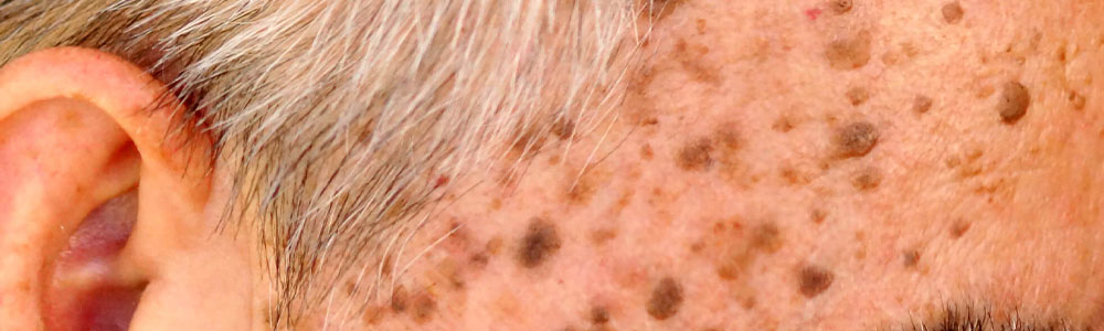 Seborrheic Keratosis