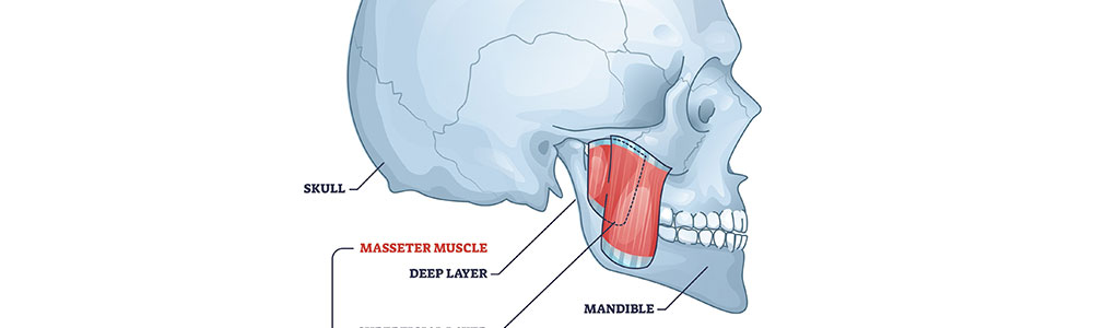 Masseter Botox