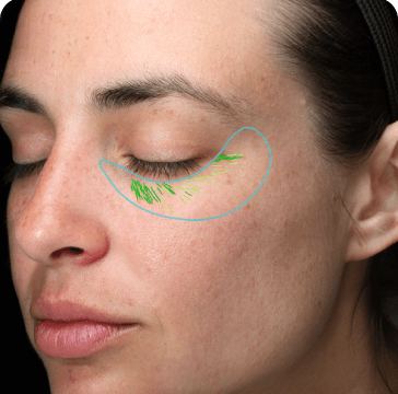 Fine lines & wrinkles