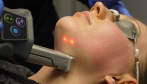 CO2 & 1570nm Fractional Laser