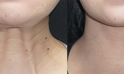 Botox for Platysmal Neck Bands