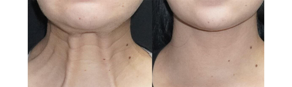 Botox for Platysmal Neck Bands
