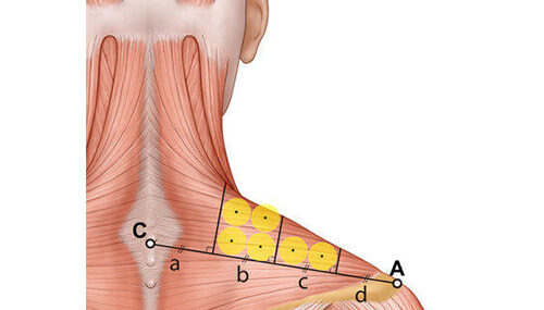 Botox for Trapezius Muscle Relief