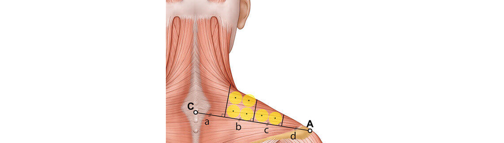 Botox for Trapezius Muscle Relief