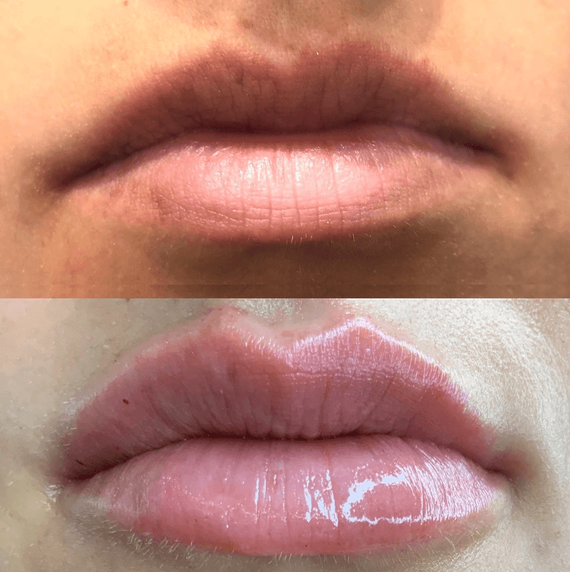 Lip Filler