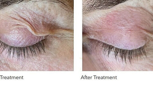 Eyelid & Under-Eye Skin Tightening vs. Surgery — Costs, Downtime, and Results