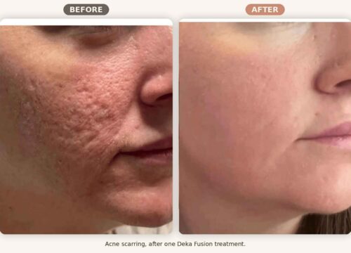 Acne Scarring