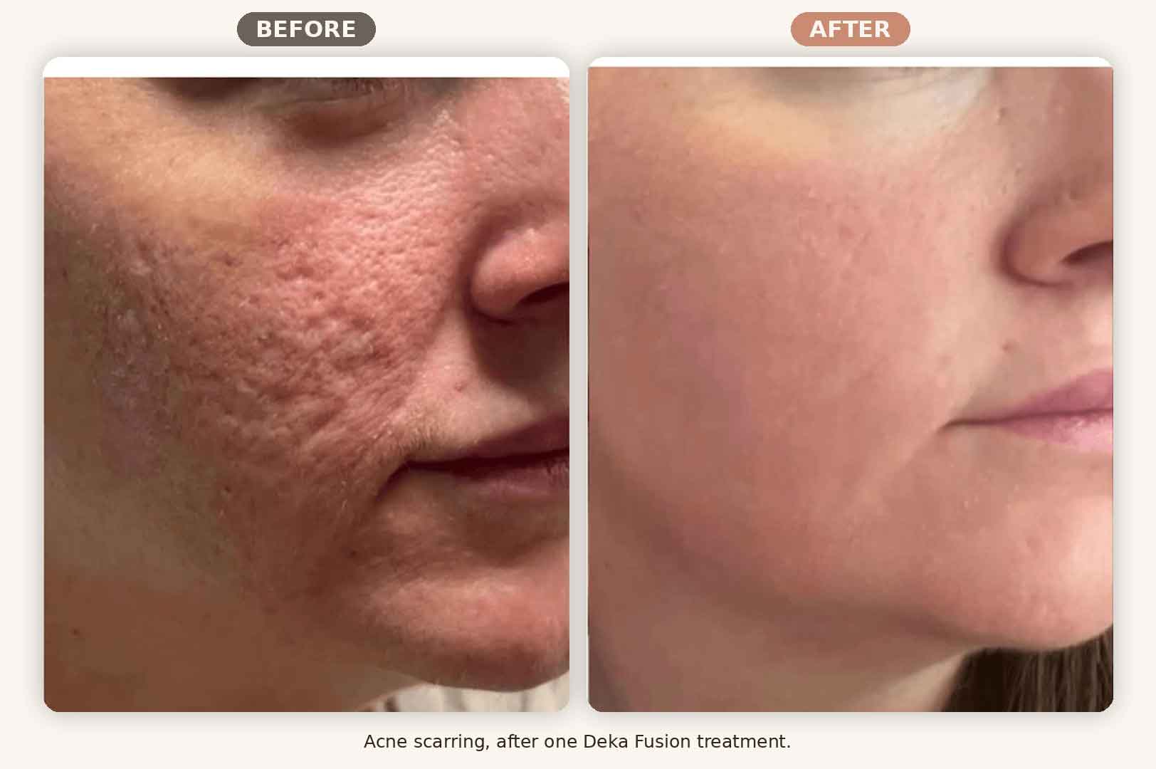 Deka Fusion before and after acne scarring, one treatment, Renew MedSpa Eagan MN
