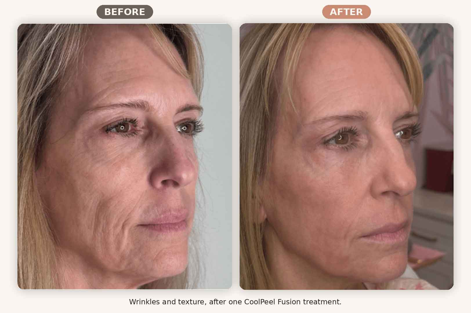 CoolPeel Fusion before and after facial wrinkles and texture, one treatment, Renew MedSpa Eagan MN